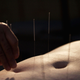 Illustration for article titled Acupuncturist Went Too Deep, Punctured Patient's Lungs